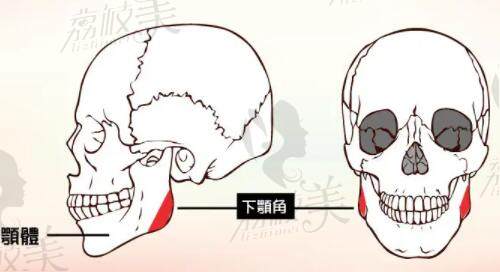 磨骨手术