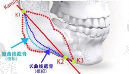 张笑天下颌角截骨理念