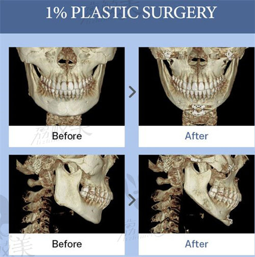 韩国1%(百分之一)整形外科下颌CT