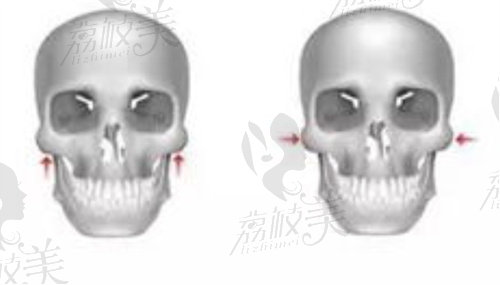 轮廓颧骨手术示意图