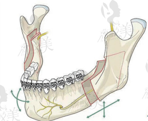 正颌手术分解3D动画示意图