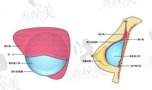 北京壹加壹隆胸