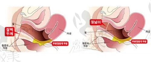 韩国好手艺妇科医院“后方膣圆盖术”