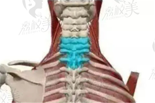 脖子后面的富贵包是什么原因形成的
