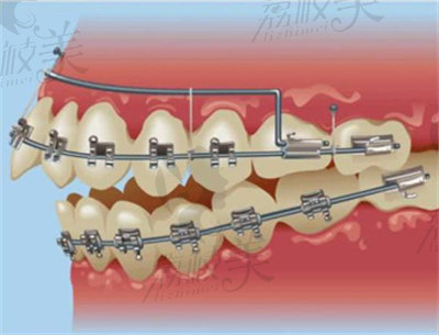 深圳美莱口腔在牙齿矫正方面的优势3