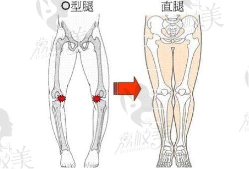 国内腿型矫正医院排名揭晓,北京/上海正规O/X型腿矫正医院直腿术一绝