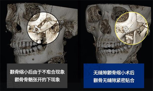 韩国美迪莹整形外科颧骨手术