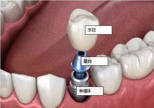 韩国奥齿泰和登腾种植体