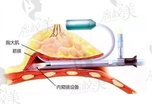 内窥镜隆胸示意图