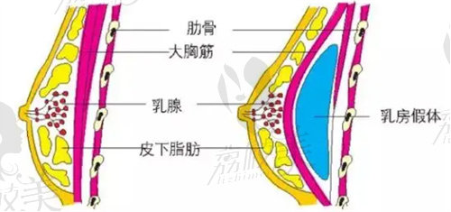 蘇州假體隆胸做的好的醫(yī)院有哪些？