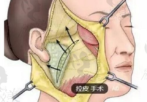 北京大拉皮手术