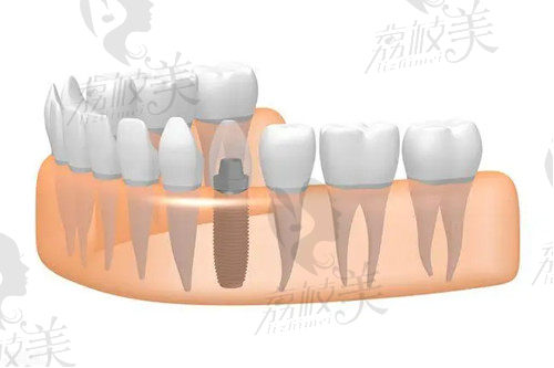 种植牙示意图