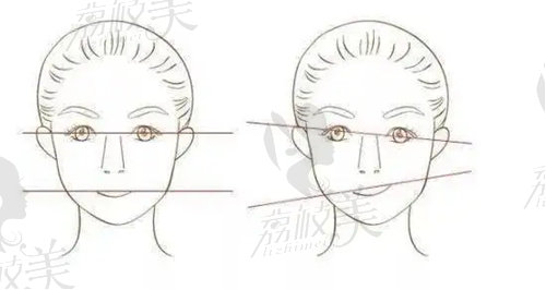 左右臉不對稱矯正需要多久才能處理