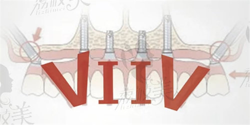 佛山鼎植口腔VIIV种植技术
