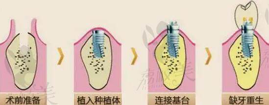 种植牙过程