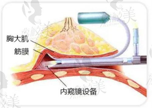 内窥镜隆胸设备