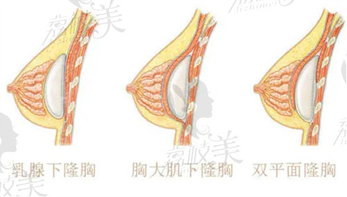 雙平面隆胸示意圖