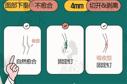 韩国原辰整形技术