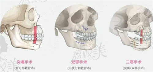 正颌手术示意图