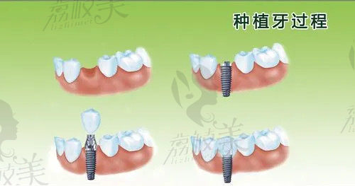 韩国奥齿泰种植牙过程