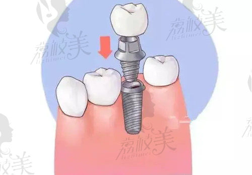 种植牙过程
