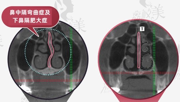 韩国TS歪鼻矫正手术