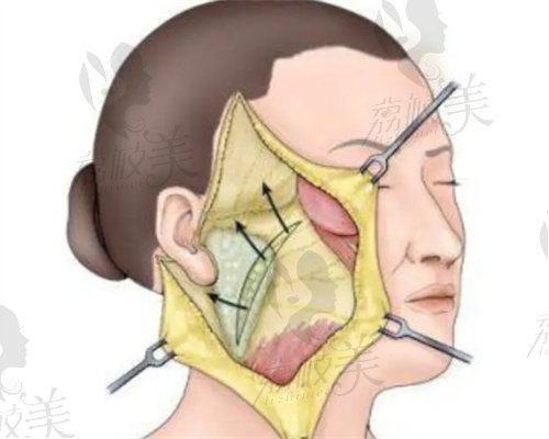 面部拉皮手术示意图