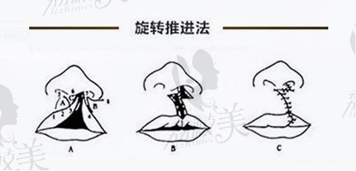 赵绛波医生唇腭裂旋转推进法