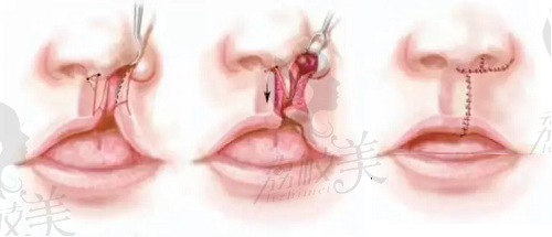 赵绛波医生唇腭裂鼻部畸形修复