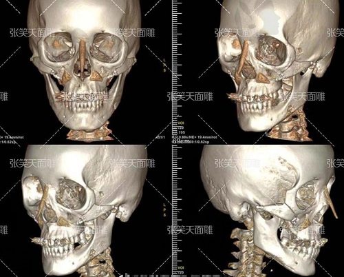 北京圣嘉新醫(yī)療美容醫(yī)院張笑天磨骨CT對(duì)比