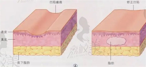 面部填充示意圖