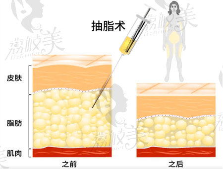 深圳富华吸脂价格多少？