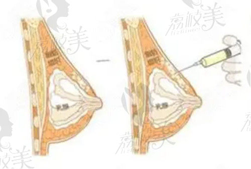 刘成胜做自体脂肪丰胸真不错