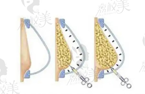 刘成胜做自体脂肪隆胸技术赞