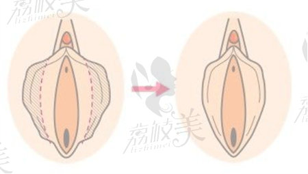 阴唇有哪几种类型？