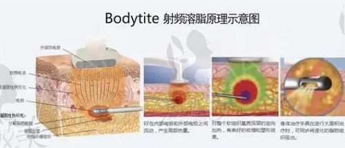黄大勇bodytite射频溶脂原理