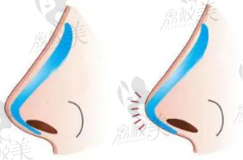 武漢美基元整形醫(yī)院隆鼻技術(shù)好