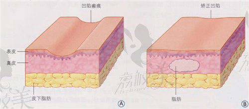 武漢美基元整形醫(yī)院吸脂技術(shù)好