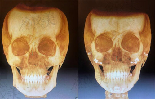 韩国欧佩拉整形外科下颌角CT