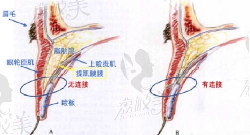 师丽丽双眼皮修复