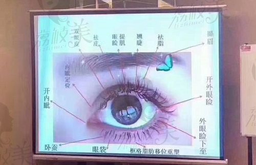 杨胜发医生割双眼皮技术