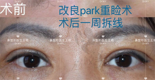 改良park法双眼皮术后1周拆线