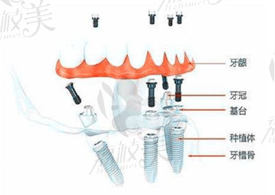 肖步挺醫(yī)生在all-on-4種植方面的技術優(yōu)勢4