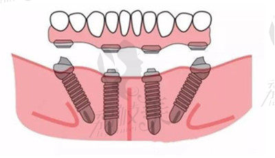 肖步挺醫(yī)生在all-on-4種植方面的技術優(yōu)勢2