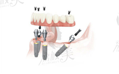 肖步挺醫(yī)生在all-on-4種植方面的技術優(yōu)勢3