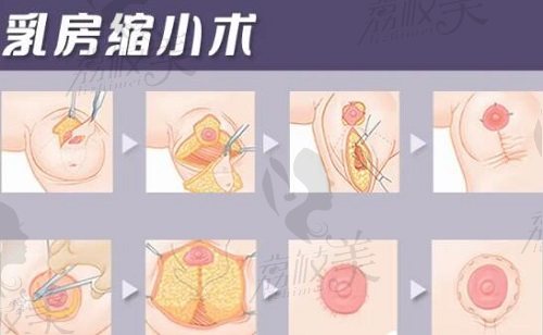 李比乳房缩小手术