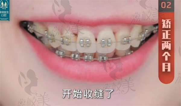 广州中家医家庭医生口腔矫正两个月