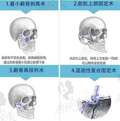 菲斯莱茵颧骨手术过程