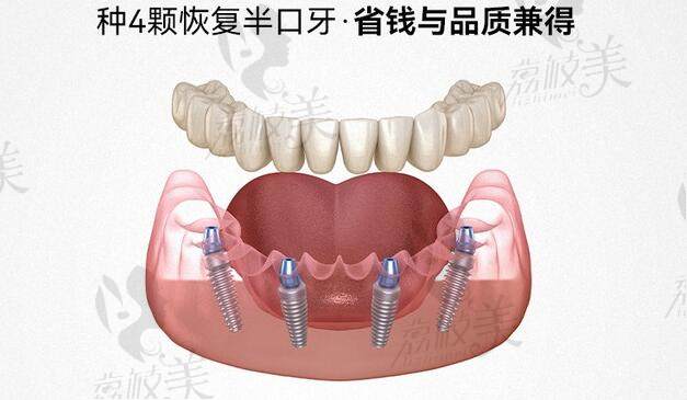 廣州柏德口腔ALL-ON-4種植技術(shù)