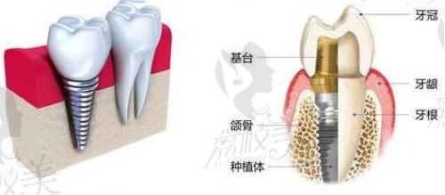 奥齿泰植体